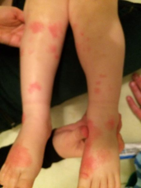 histamine